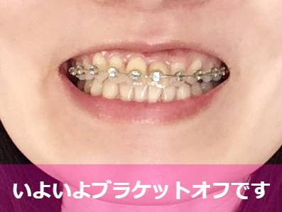 メタルブラケットで矯正中