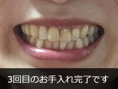 スパークリングイレーサー3回目完了後の歯 スパークリングイレーサー3回目完了後の歯